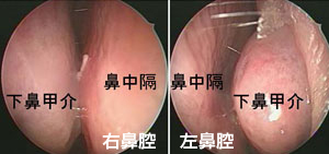 右鼻腔・左鼻腔