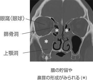 副鼻腔の形態