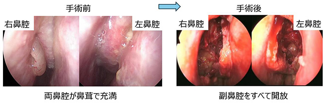 手術前と手術後の変化写真。手術前は両鼻腔が鼻茸で充満し、手術後はすべて開放されている。
